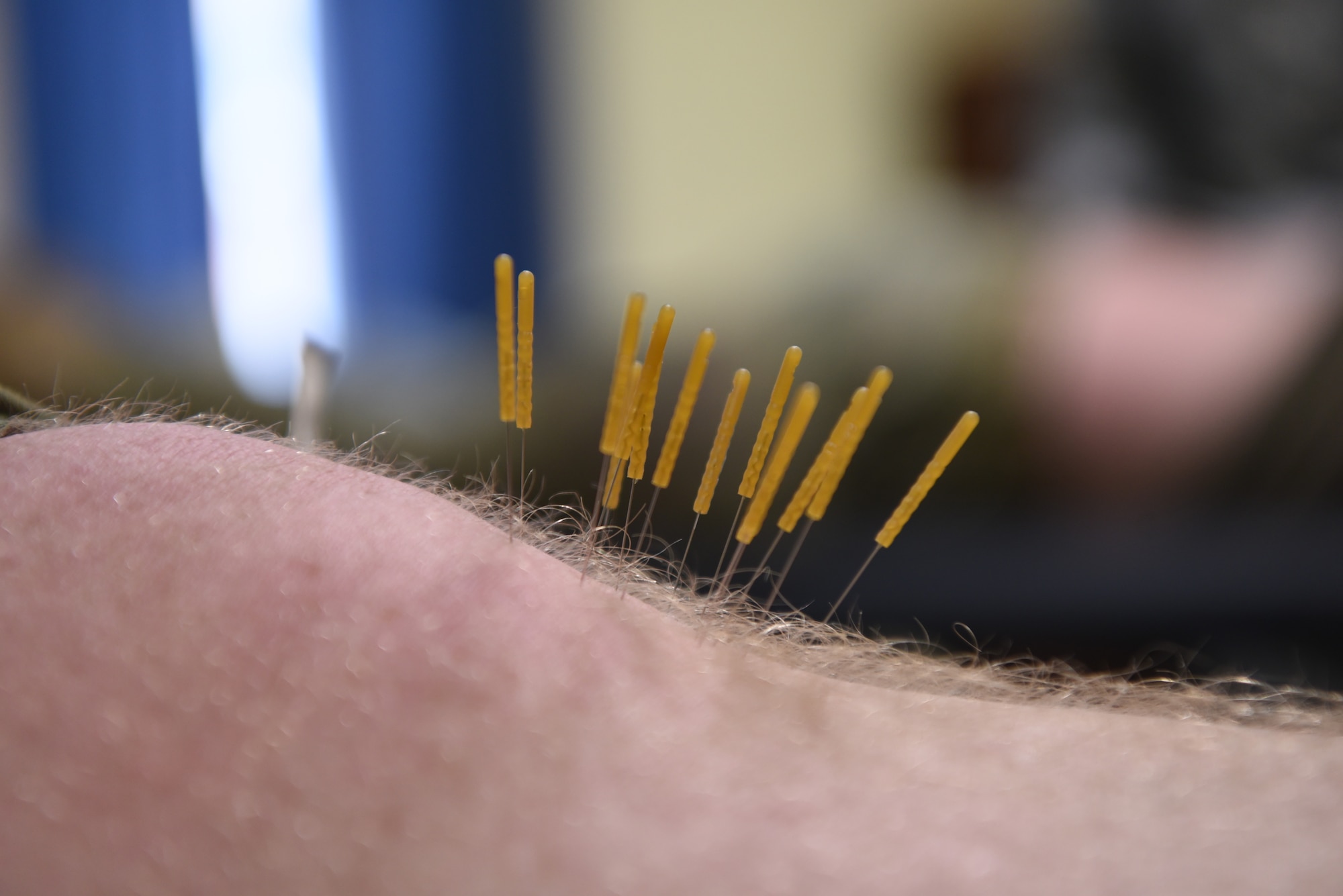 Needles sit in a 890th Missile Security Forces Squadron defenders knee during a dry needling procedure performed by Capt. Eric Walter, 90th Medical Operations Squadron physical therapy flight commander, during a weekly squadron visit Feb. 4, 2019, at F.E. Warren Air Force Base, Wyo. The 90th MDOS PT team has acknowledged the need for appointments for defenders who are unavailable during the regular duty hours and has put together a physical therapy program, specifically for defenders, allowing them to receive the proper treatment. (U.S. Air Force photo by Senior Airman Abbigayle Williams)