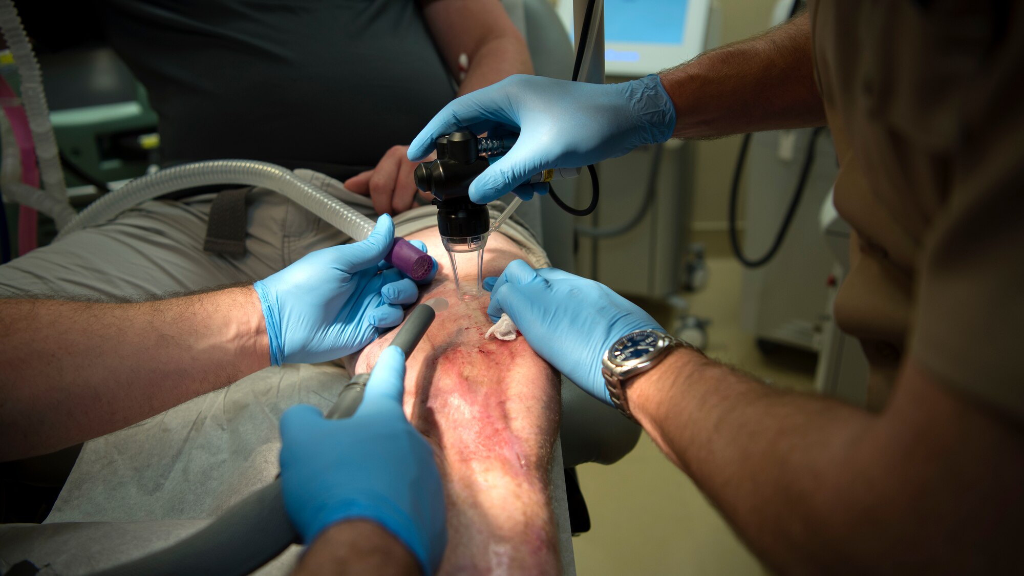 Ret. U.S. Army Staff Sgt. Daniel Burgess, a wouded warrior, receives a carbon dioxide laser treatment at the MacDill Air Force Base, Fla., scar clinic Feb. 15, 2019. The wounded-warrior-focused clinic offers a variety of treatments for those who suffer from scarring as a result of blast injuries, burns, amputations, and other surgeries.