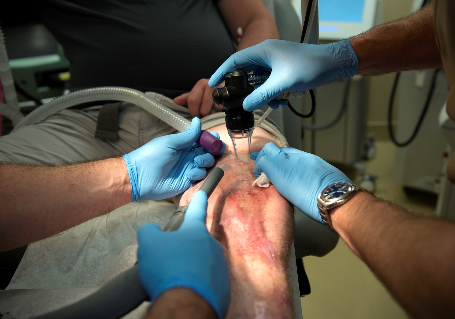 Retired Army Staff Sgt. Daniel Burgess, a wounded warrior, receives a carbon dioxide laser treatment at the MacDill Air Force Base, Florida, scar clinic Feb. 15, 2019. The wounded-warrior-focused clinic offers a variety of unique treatments for those who suffer from scarring as a result of blast injuries, burns, amputations, and other surgeries.