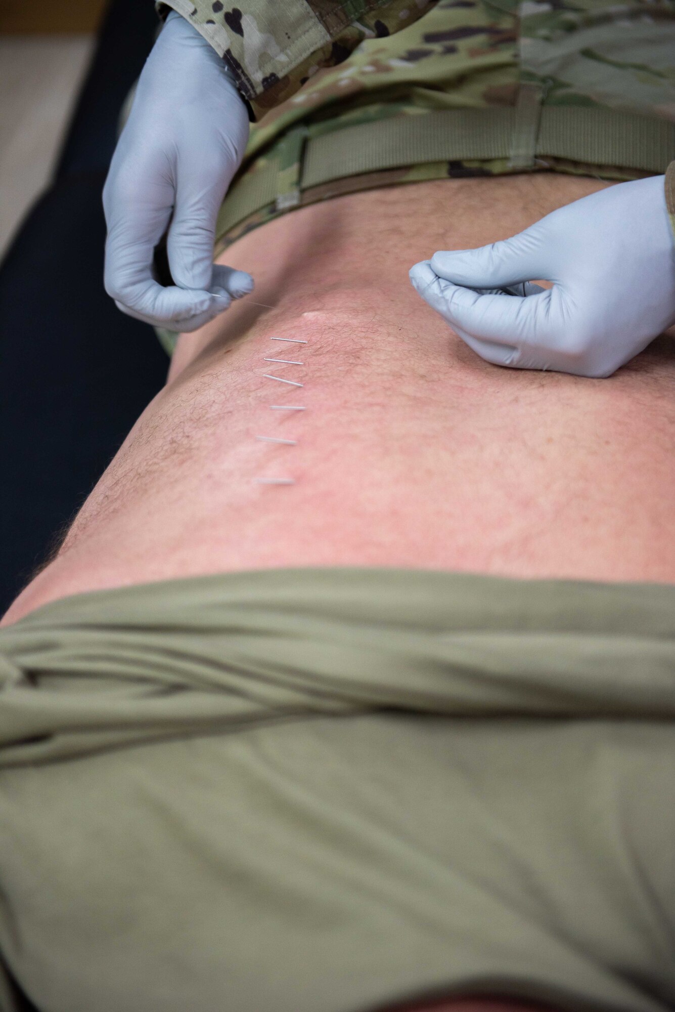 Maj. Adam Frost, 380th Expeditionary Medical Group physical therapist, removes a needle from a patients back May 17, 2019 at Al Dhafra Air Base, United Arab Emirates. Fry involves dry needling, a form of acupuncture, and cupping into his treatments – he has found both to be extremely effective at targeting trigger points, releasing muscle spasms and alleviating pain. U.S. Air Force photo by Staff Sgt. Chris Thornbury)