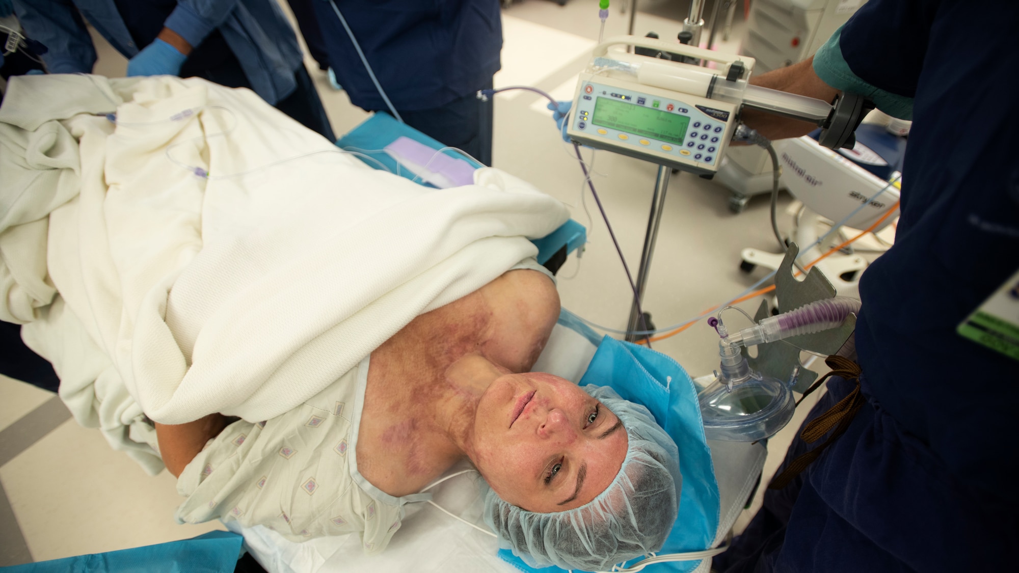 Burn scars are visible as retired U.S. Army Capt. Katie Blanchard awaits surgery Sept. 6 at Wilford Hall Ambulatory Surgical Center, Joint Base San Antonio-Lackland. Blanchard underwent fractionated carbon dioxide laser surgery to treat her injuries.