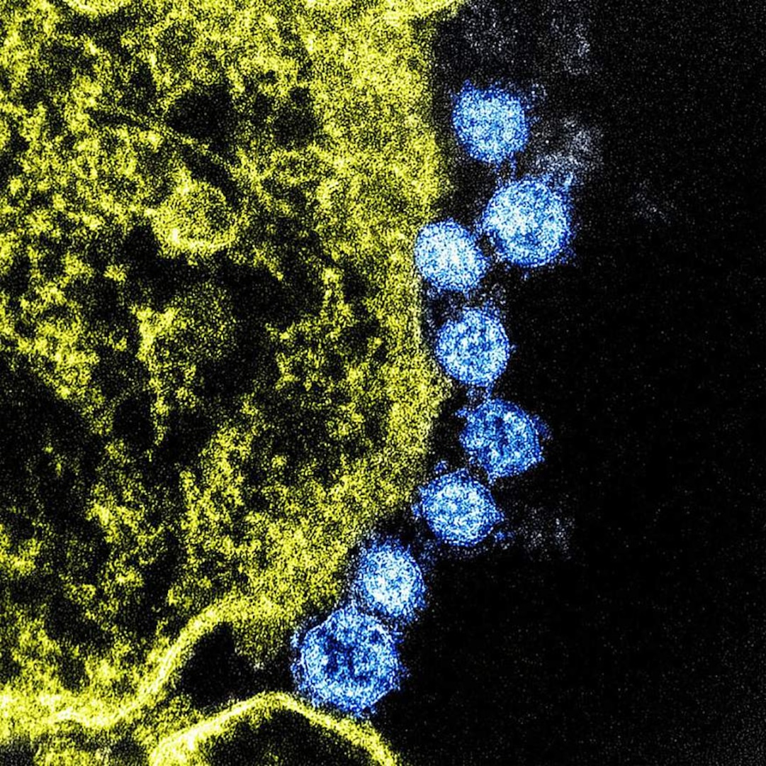 The Centers for Disease Control and Prevention has said that the coronavirus, named 2019-nCoV, is similar to the Middle East Respiratory Syndrome coronavirus in that it is spread from animals to people. The MERS virus particles are in blue, surrounding an infected cell. The undated image was taken at Fort Detrick, Maryland.