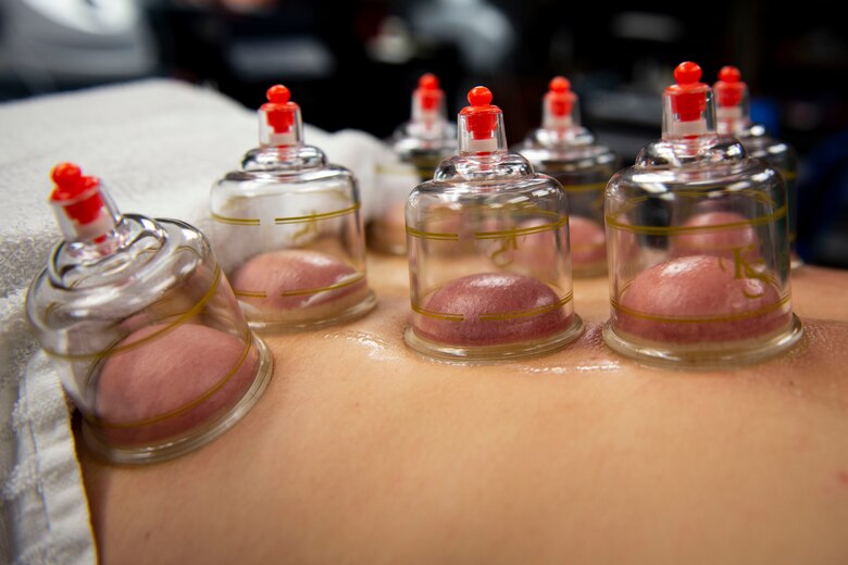 Photo of a patient rests during air cupping therapy.