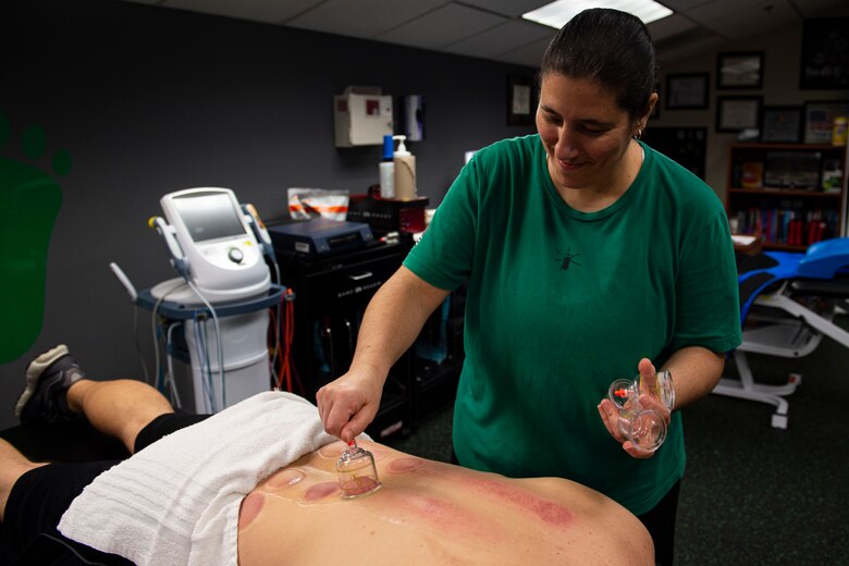 Photo an athletic trainer removes cups from a patient’s back.