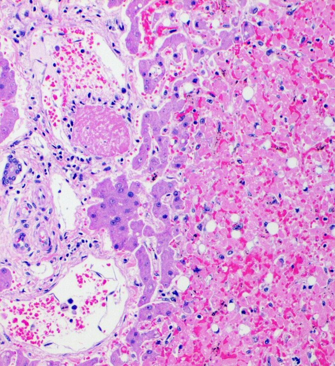 Routine H&E staining of a liver with necrosis