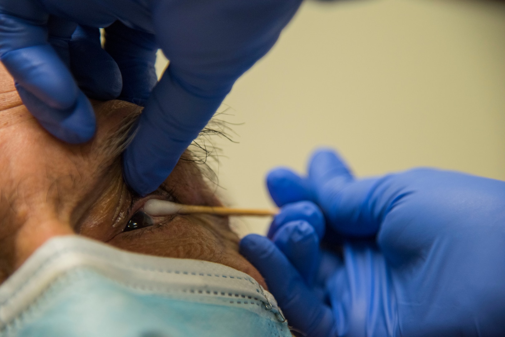 A patient's eye is numbed to prevent sudden movements and ensure accuracy of an intra-ocular injection.