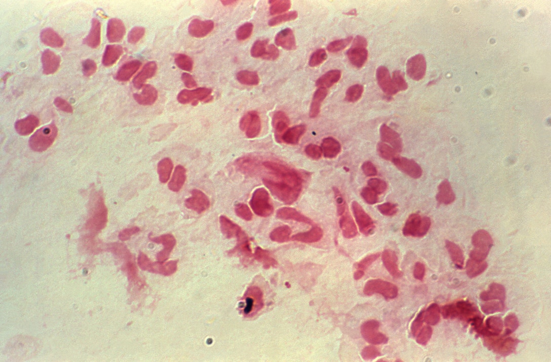 This photomicrograph of a Gram-stained urethral discharge specimen, revealed some of the histopathology associated with a case of gonorrhea, which was confirmed as culture-positive, even though very few extracellular diplococci were observed. Gonorrhea is caused by the Gram-negative bacterium, Neisseria gonorrhoeae.
