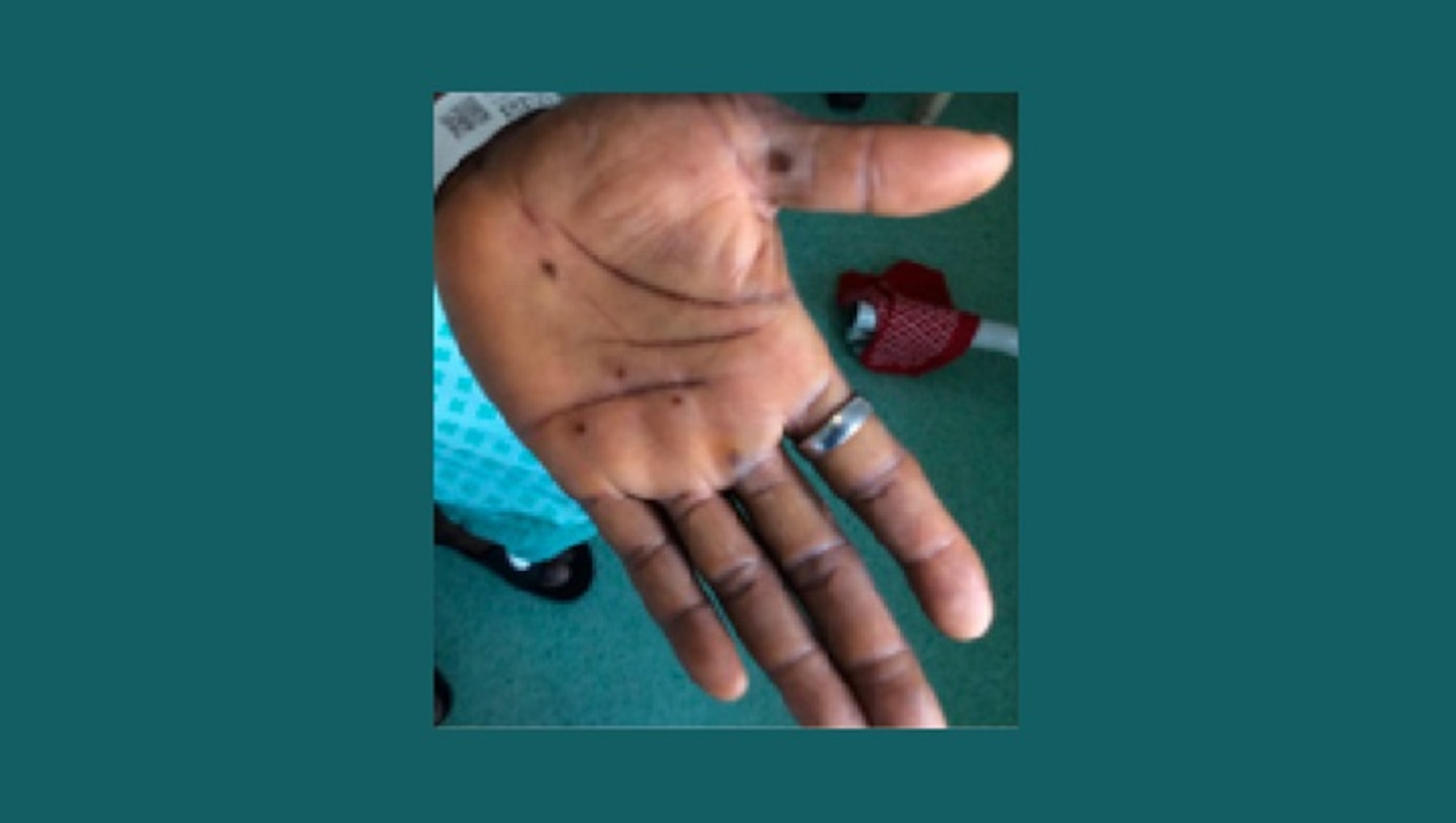 image showing monkeypox