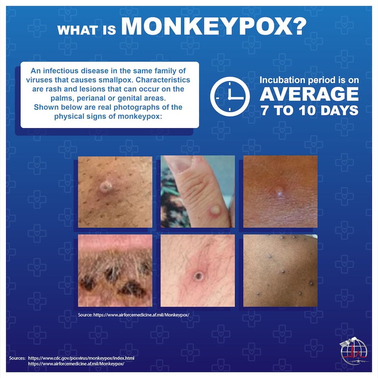 Monkeypox: What Is It, Causes, and More
