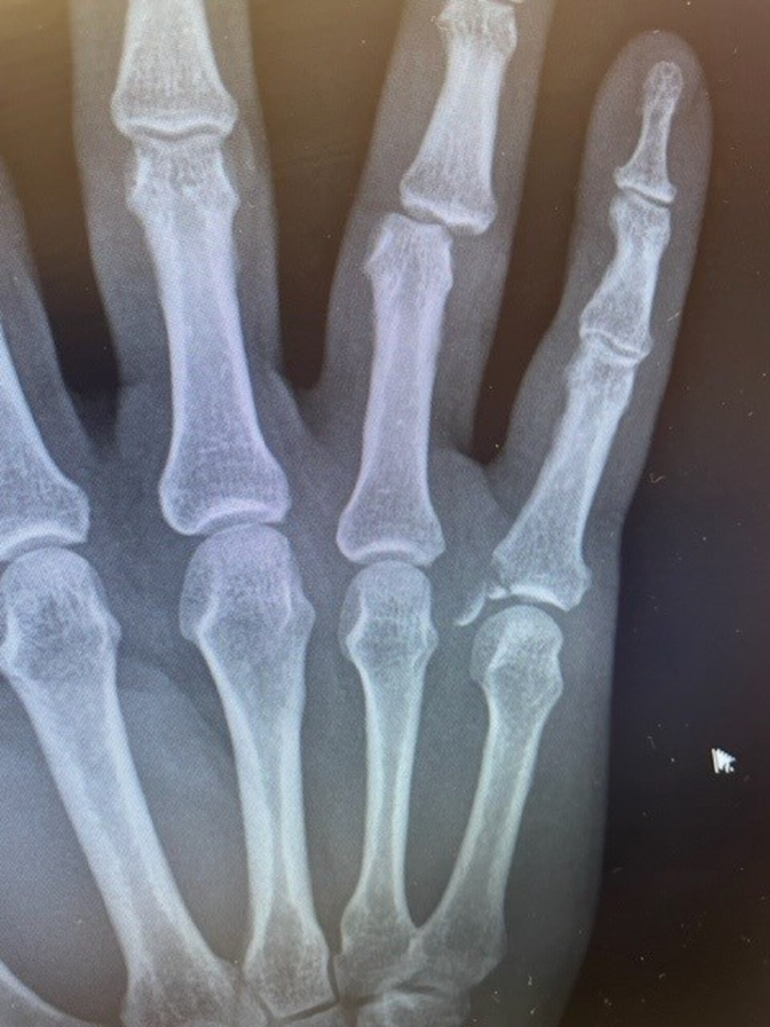 an x-ray of a hand with dislocated fingers