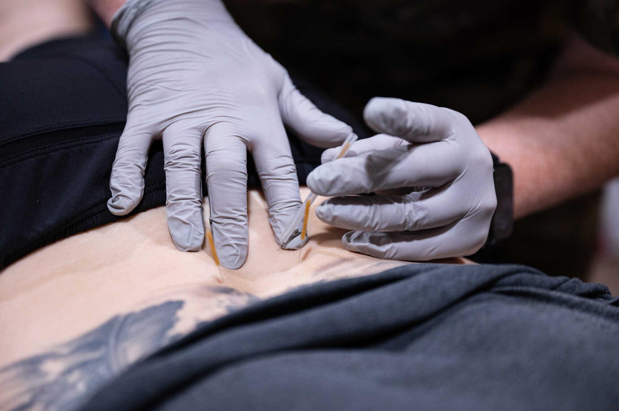 U.S. Air Force Captain Kara Heath, a physical therapist from the 379th Expeditionary Operational Medical Readiness Squadron, Al Udeid Air Base, Qatar, uses dry needling on an Airman’s lower back to activate trigger points which help to alleviate pain, June 10, 2022. Being treated with dry needling is one of several facets of the treatment this Airman received as part of his physical therapy treatment session. (U.S. Air Force photo by Staff Sgt. Dana Tourtellotte)