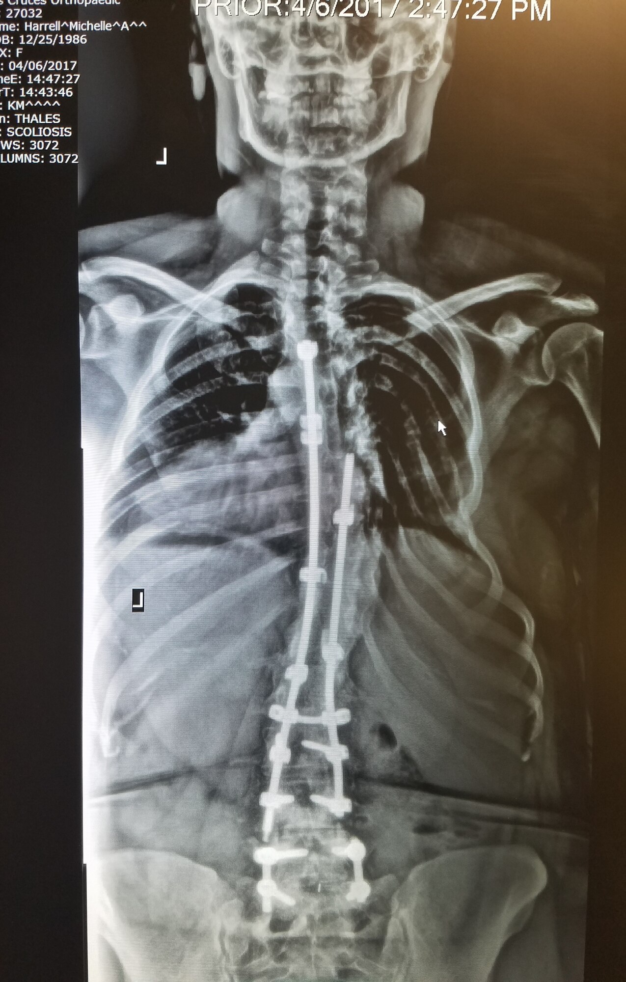 An X-ray photo of Michelle Harrell displaying the metal implants in her spine from her previous surgeries taken on April 6, 2017. (Courtesy photo)
