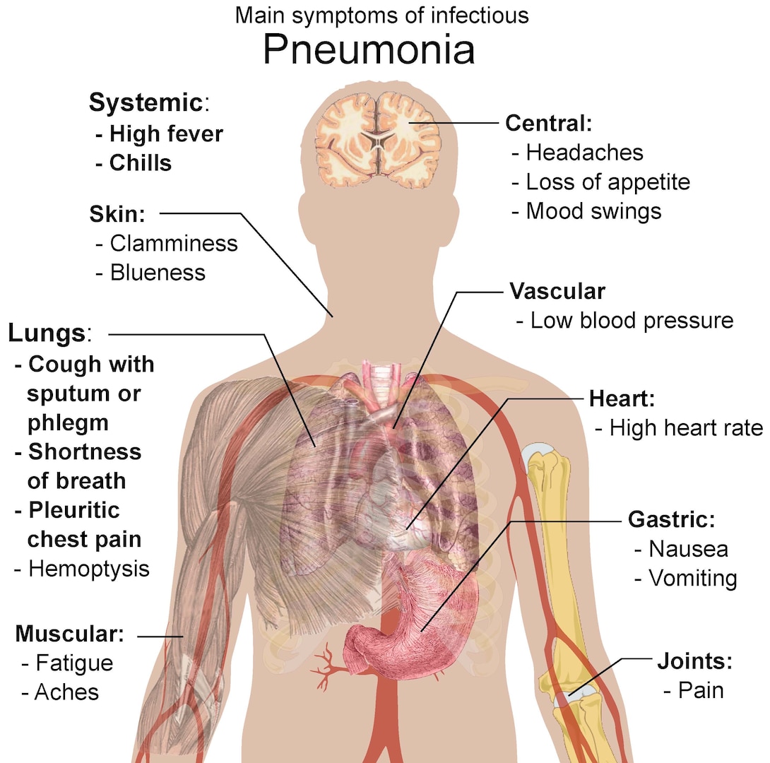 A graphic that points to locations on human body pneumonia where symptoms may present.