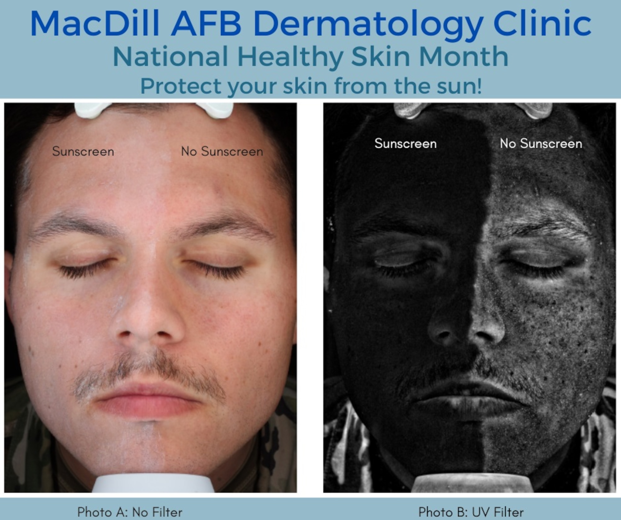 U.S. Air Force Staff Sgt. Jacob Levering, 6th Healthcare Operations Squadron, models the importance of sunscreen. Photo A, left, demonstrates his skin with and without sunscreen application. Photo B, right, is the same photo with an ultraviolet filter applied. Photo B demonstrates the UV-blocking abilities of his sunscreen on, the right half of his face, compared to the UV penetration without sunscreen on, the left half of his face. (U.S. Air Force graphic)