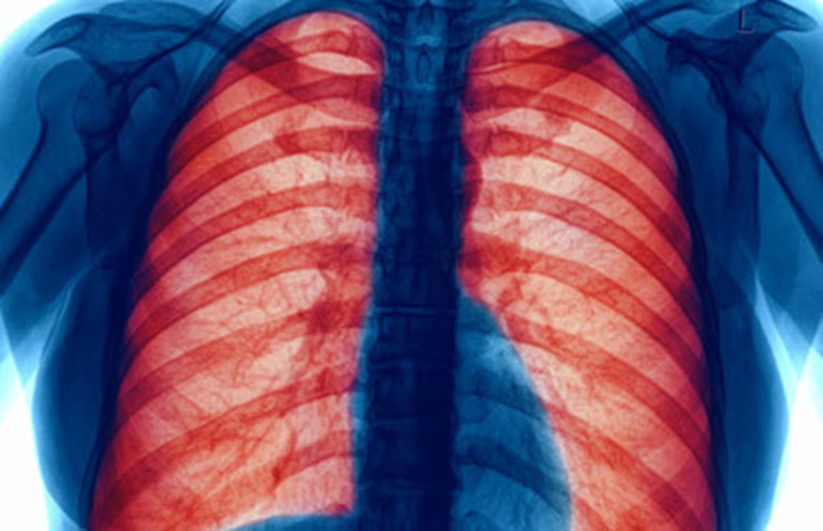 COPD makes breathing difficult for the 16 million Americans who have this disease. Millions more people suffer from COPD but have not been diagnosed and are not being treated, according to the Centers for Disease Control and Prevention (CDC).