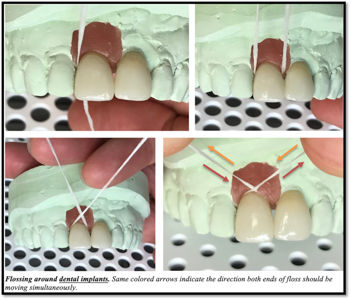 Flossing around dental implants