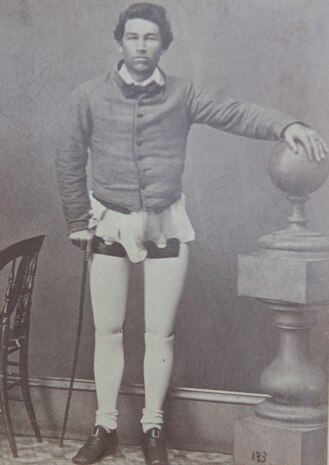 A photograph at the National Museum of Health and Medicine in Silver Spring, Maryland shows an amputee during the Civil War era fitted with prostheses.