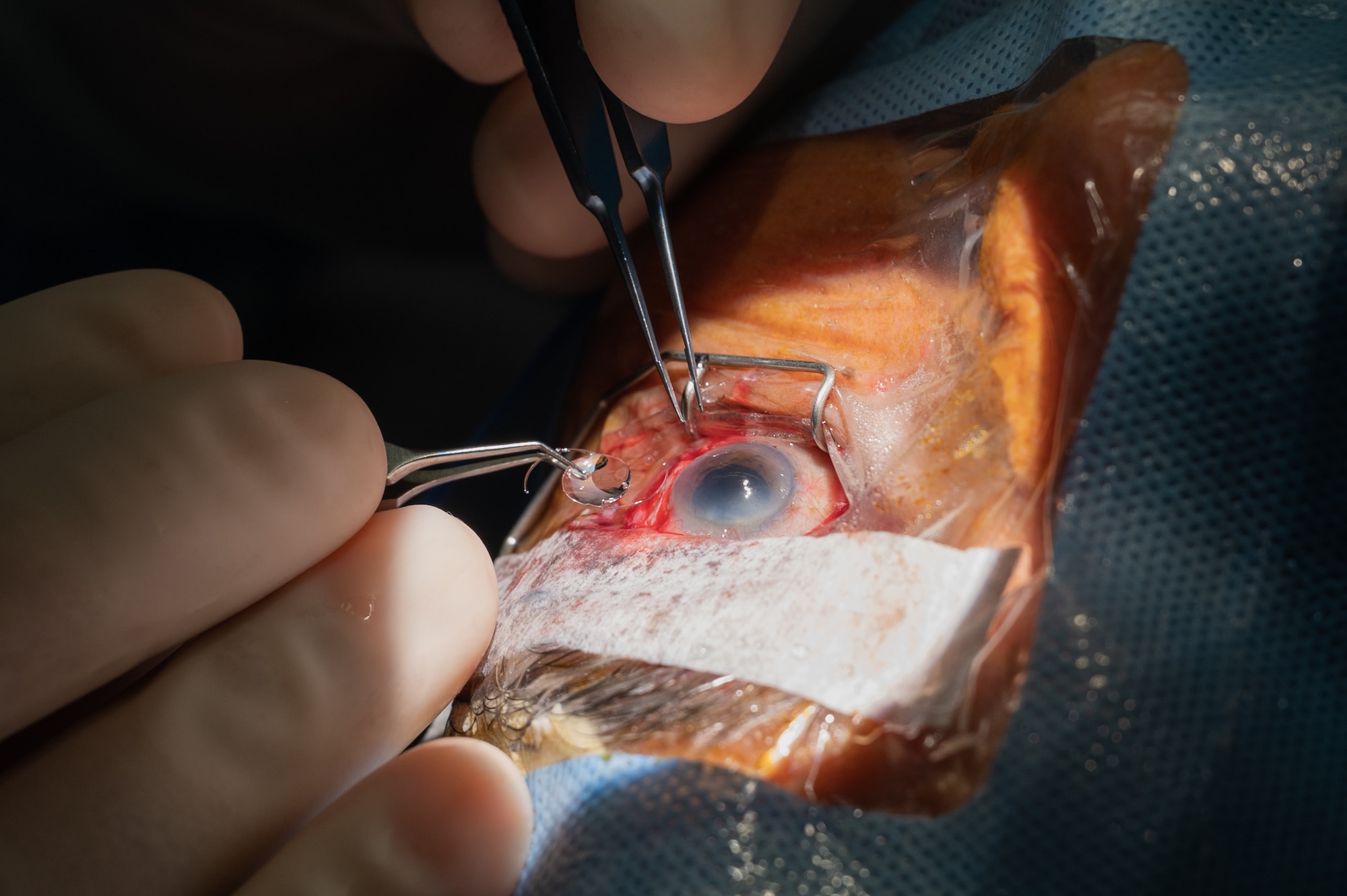 Image of an intraocular lens (IOL) being implanted into a patient's eye after successfully removing the cloudy lens during manual small incision cataract surgery.