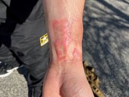 Daniel Pereyra shows the scars of where his skin was grafted