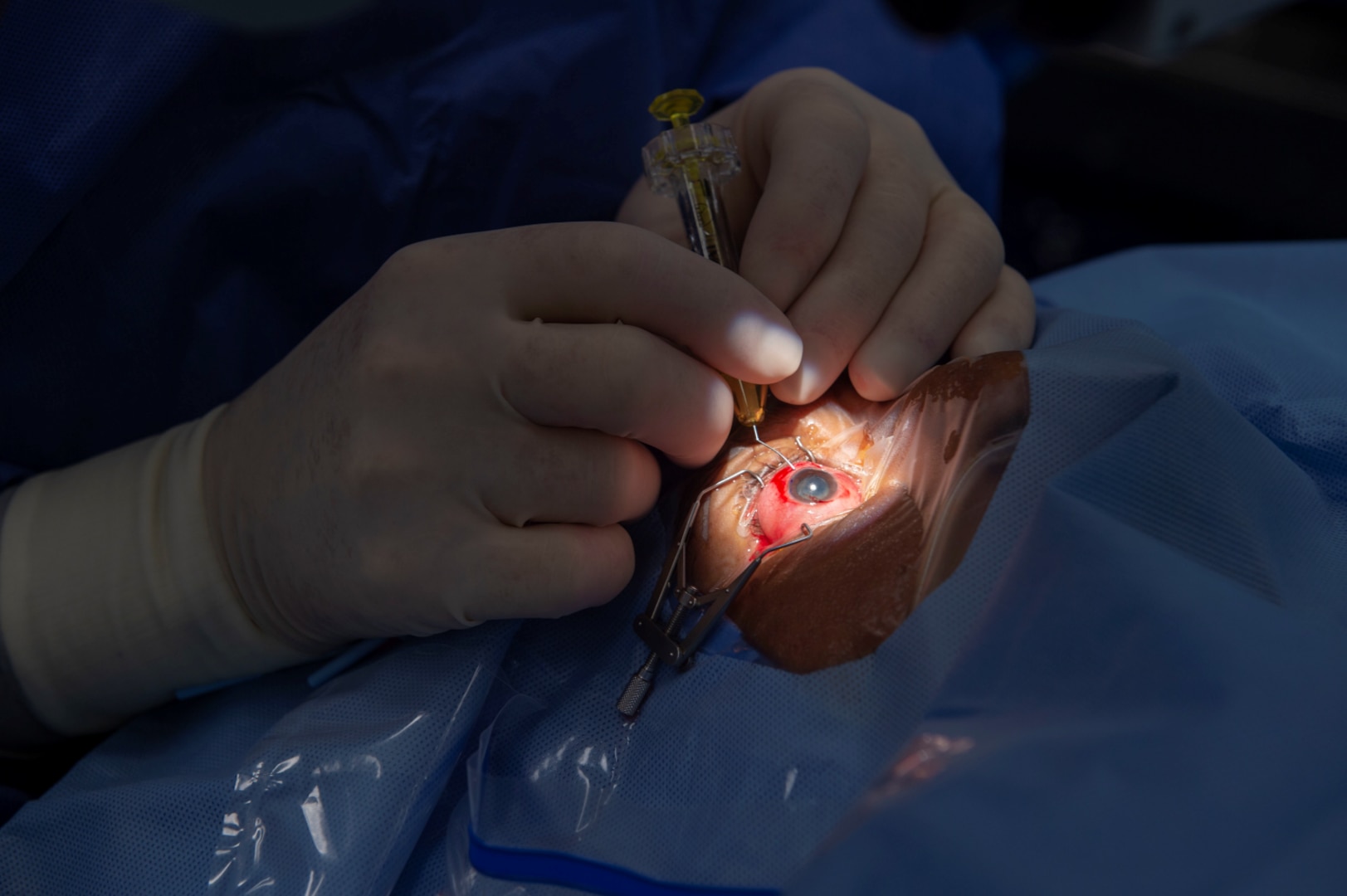 Surgeon operates on eyeball.