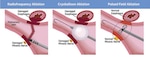 An illustration shows safety concerns with radiofrequency ablation versus cyroballoon ablation versus pulsed field ablation.
