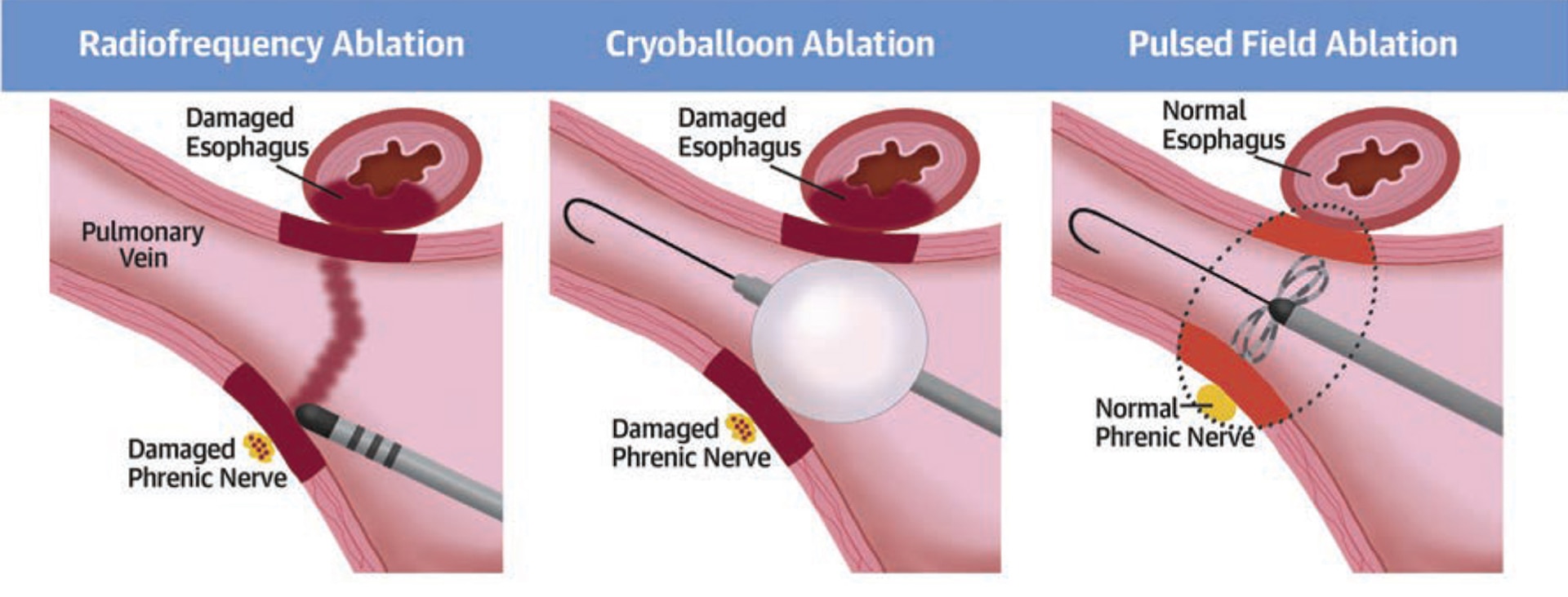 An illustration shows safety concerns with radiofrequency ablation versus cyroballoon ablation versus pulsed field ablation.