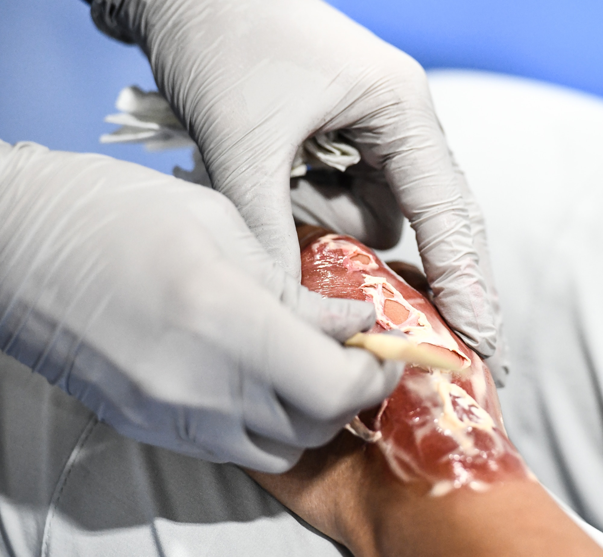 medic applies moulage