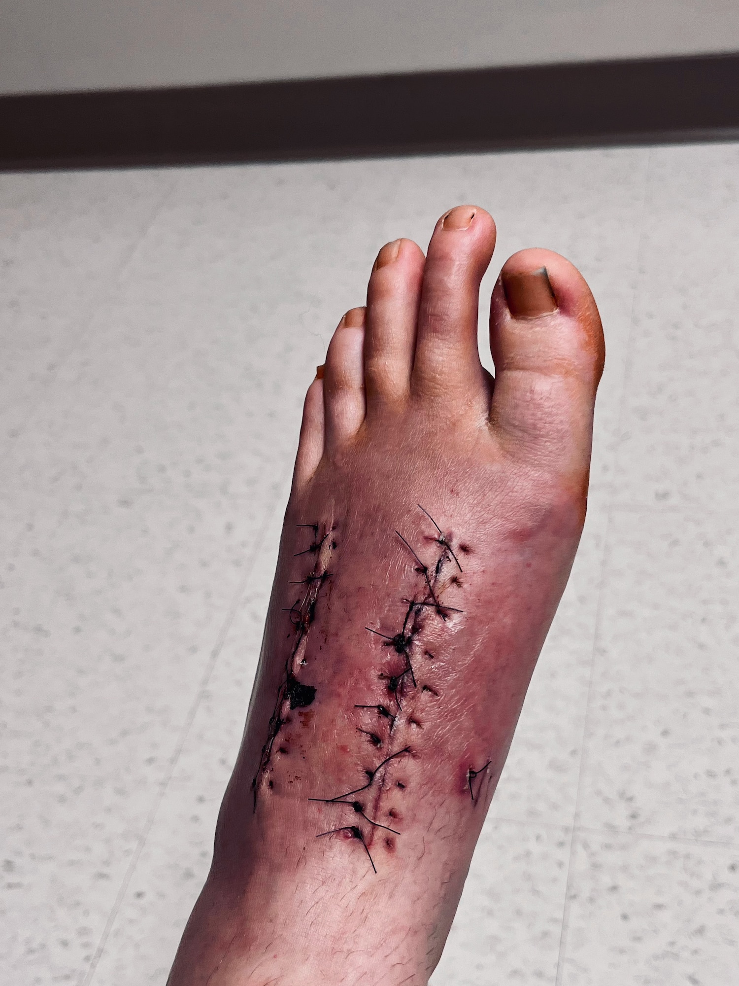 Foot with stiches