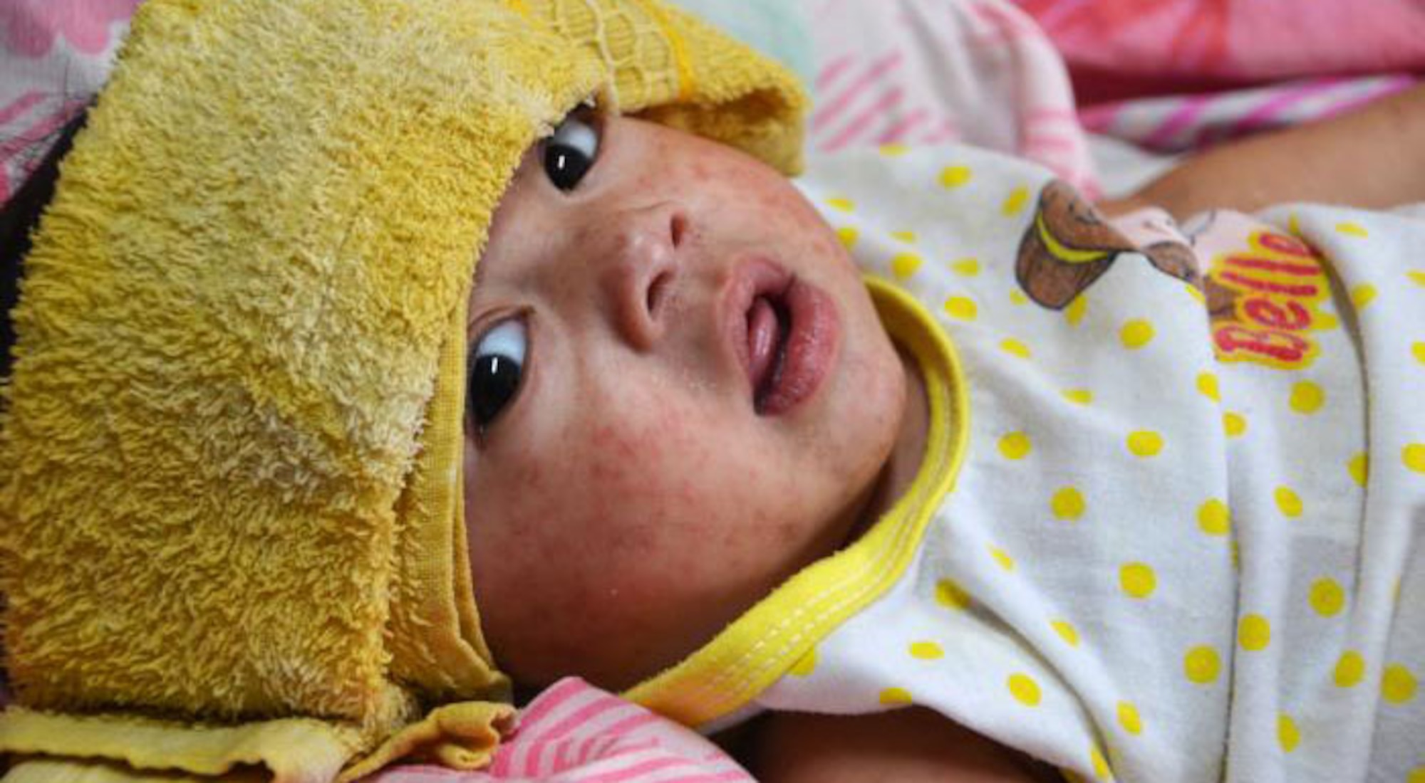 Measles has arrived in California, but there’s still time to keep your family safe. While most of the U.S. cases have been in unvaccinated communities in Texas and New Mexico, cases have been reported from Rhode Island to Alaska. Here in California, five cases have been reported, including two infectious patients at Los Angeles International Airport in February and early March.