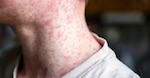 The Fort Riley Department of Public Health is closely monitoring a growing measles outbreak in Southwest Kansas and preparing for the possibility of further spread.