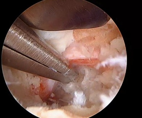 251217-N-TW242-1005 Okinawa, Japan Dr. Lawless performing the procedure in the USNHO OR under the high powered laparoscope. (U.S. Navy photo courtesy asset)