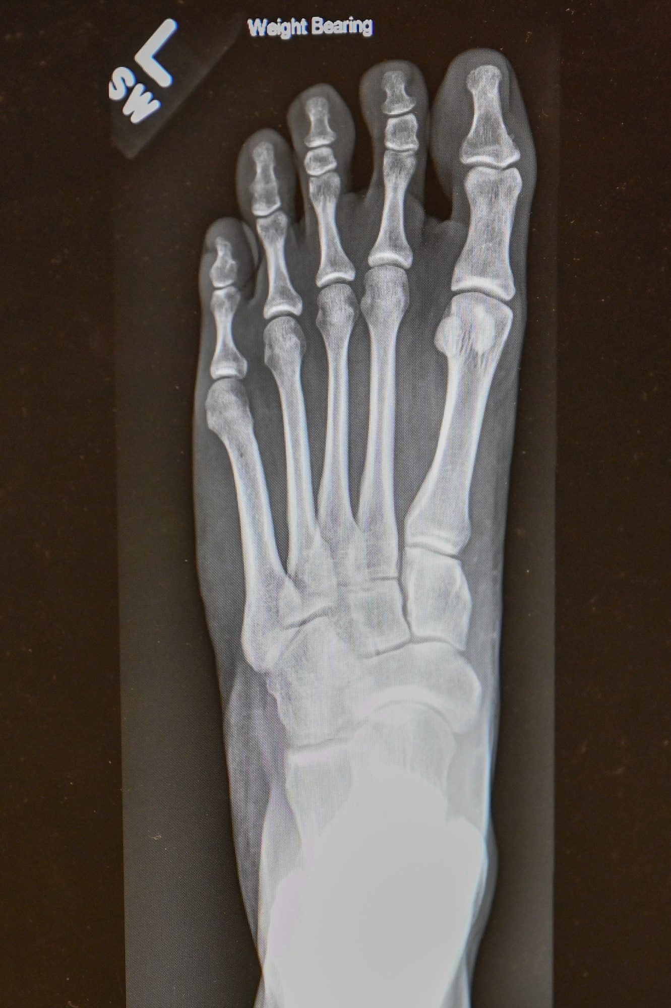 Photo of an x-ray of a foot.