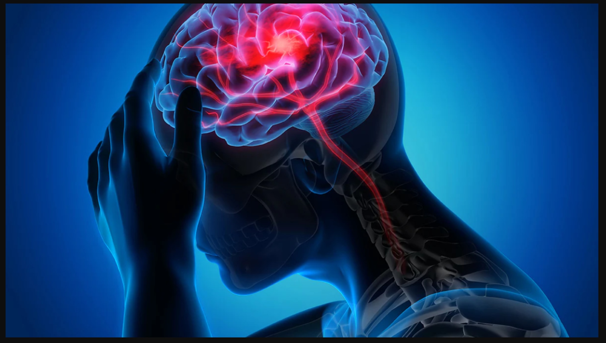 Image of a brain, Understand the signs of stroke and how to prevent them.