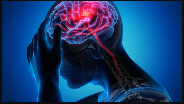 Image of a brain, Understand the signs of stroke and how to prevent them.