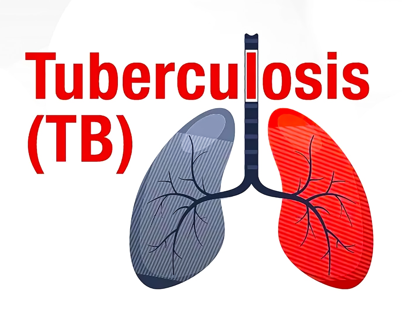 We want to provide important information about tuberculosis (TB) prevention and general health practices in light of recent TB cases being monitored in Kansas City. While the situation is improving, we want to ensure our community stays informed and healthy.