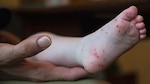 Image of baby's foot covered with skin rash