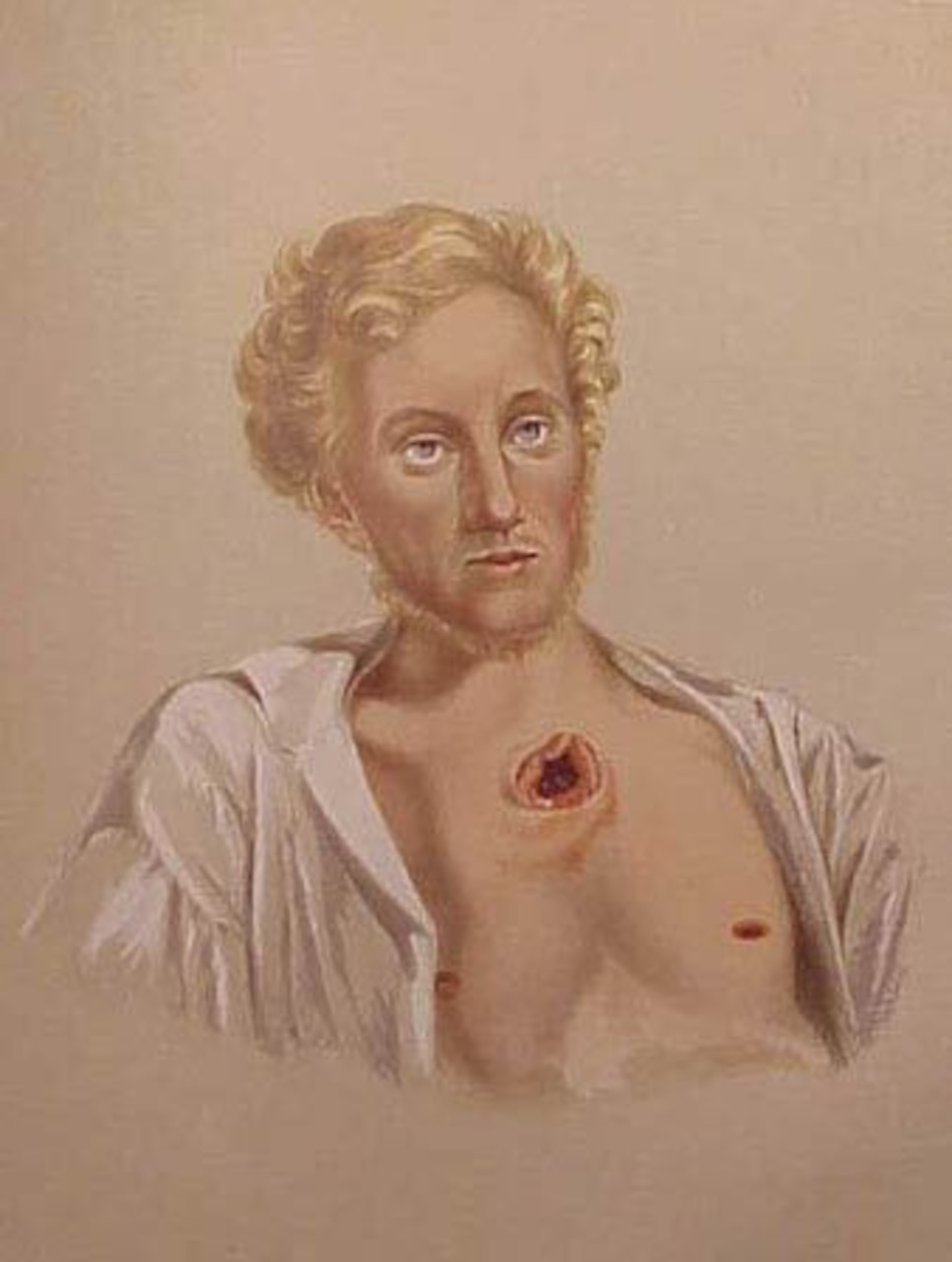A painting shows a man with a gaping chest wound.