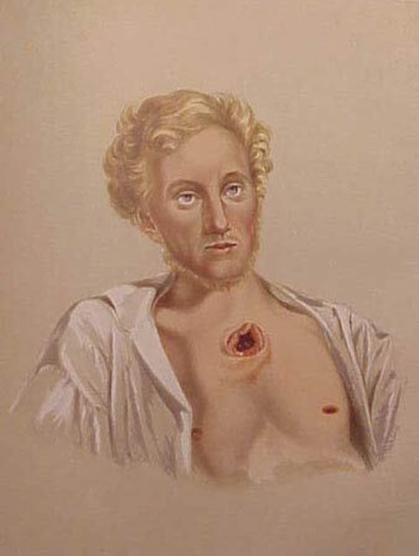 A painting shows a man with a gaping chest wound.