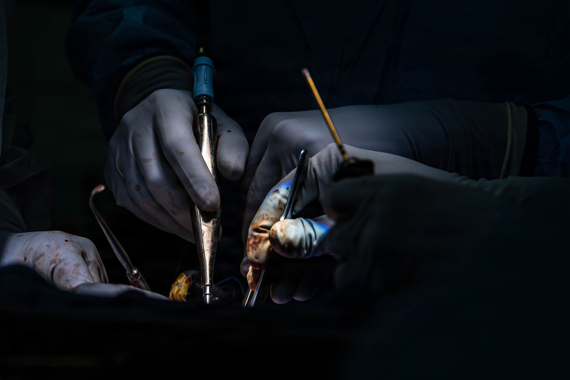 U.S. Air Force Airmen assigned to 86th Dental Squadron carry out bilateral sagittal split osteotomy surgery at Landstuhl Regional Medical Center, Germany, Jan. 29, 2026.