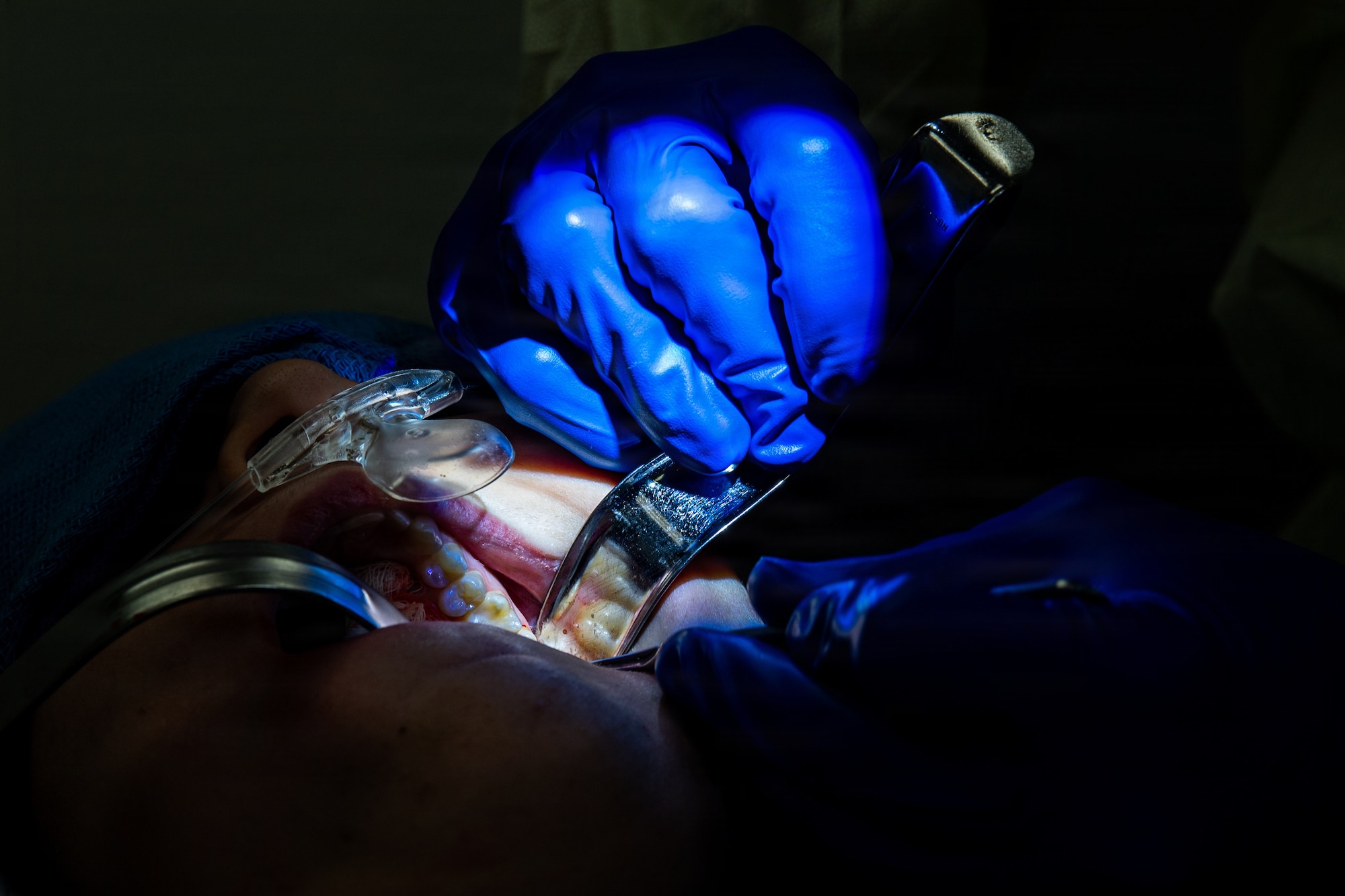 U.S. Air Force Maj. Matthew Van Hoof, 86th Dental Squadron oral and maxillofacial surgeon,  performs an oral tooth extraction surgery at Ramstein Air Base, Germany, Jan. 13, 2026.