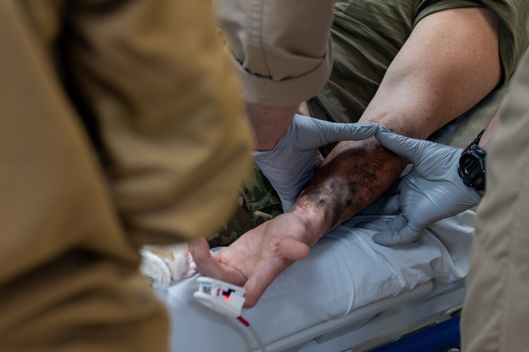 Checking simulated Arm Burns
