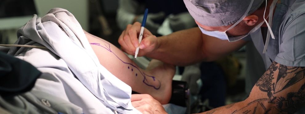 A surgeon marks the surgical site on a patient's leg with a black marker.